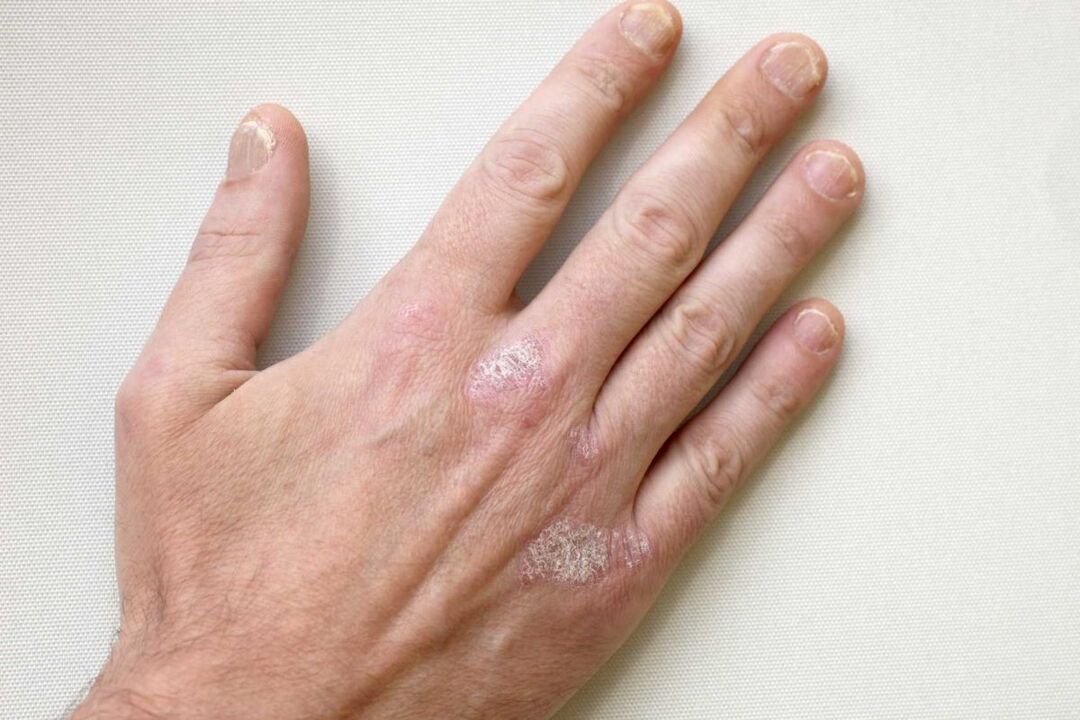 Treatment of psoriasis on male hands with Keramin cream
