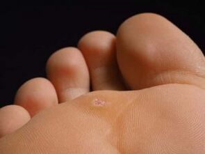 Causes of sole warts