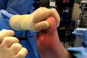 Surgery to remove warts