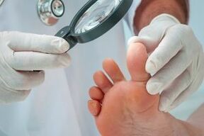Treatment of sole warts