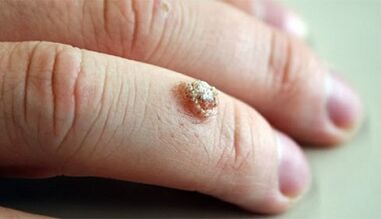 How to treat warts with celandine