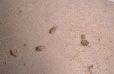 Papilloma