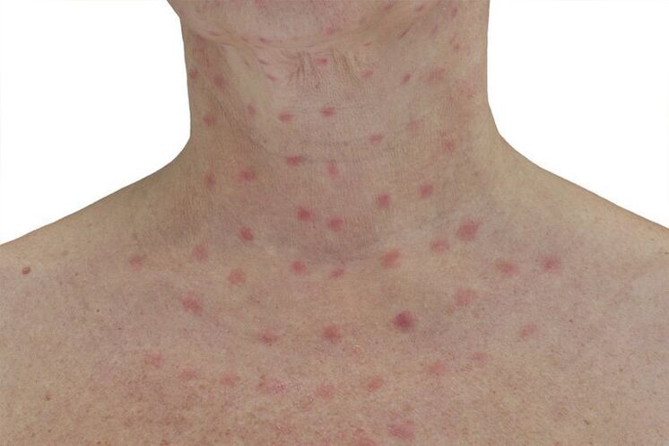 Electrocoagulated skin