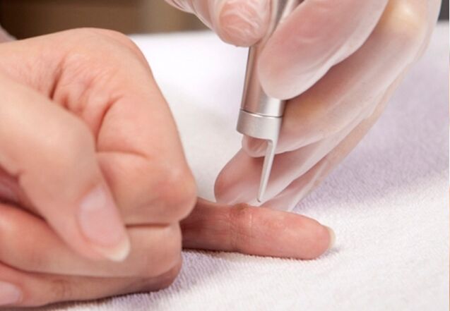 remove warts on fingers