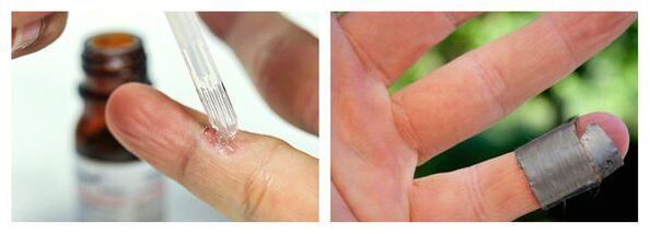 Chemical methods for treating warts