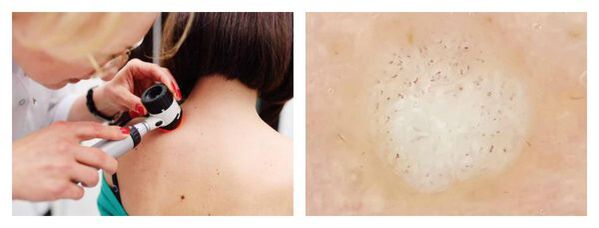 Dermatoscope for warts