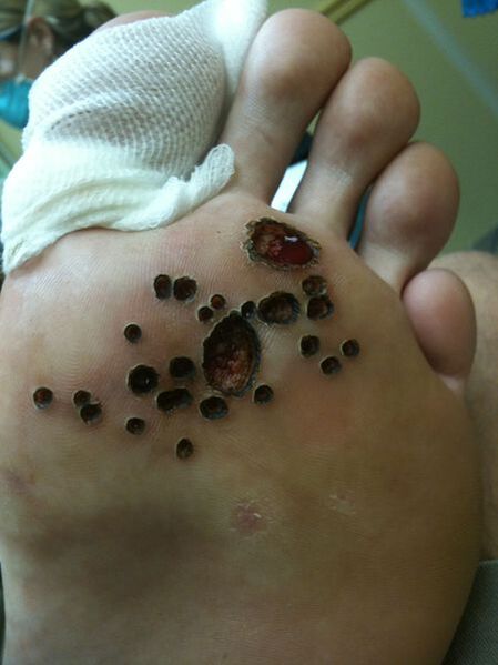 Laser removal of warts on the legs