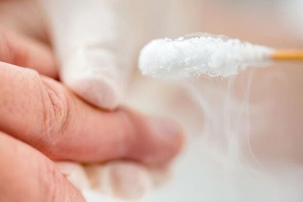 Treat warts with liquid nitrogen