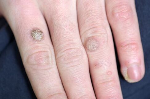 wart
