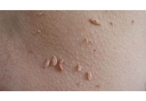 A sign of HPV infection is the presence of papillomas in the body