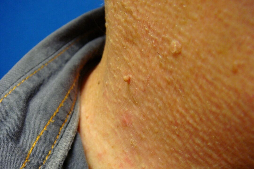 Papilloma on human neck