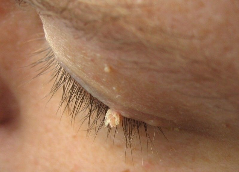 Warts are in front of us