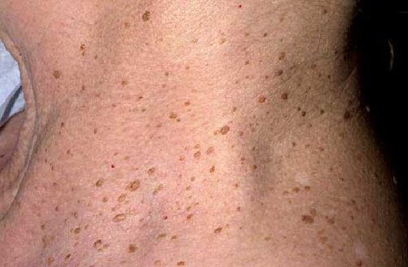 Warts in the elderly