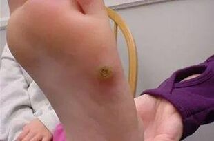 wart