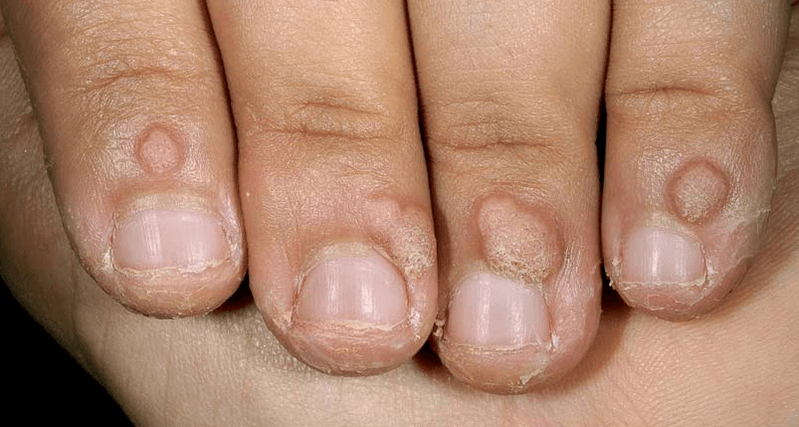 wart