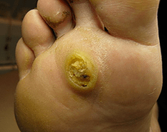 Subpapilloma